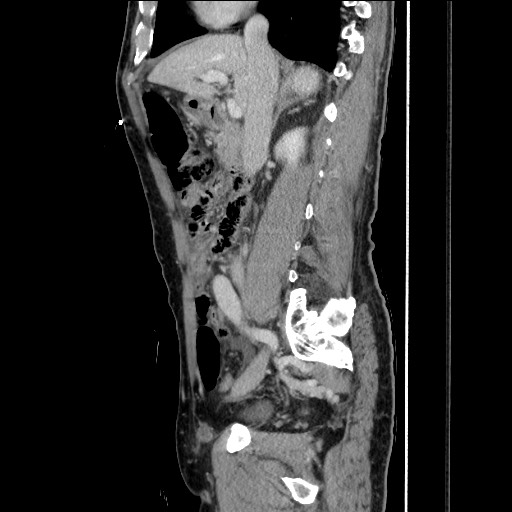 Closed loop small bowel obstruction - omental adhesion causing "internal hernia" (Radiopaedia 85129-100682 C 76).jpg