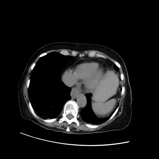 File:Closed loop small bowel obstruction due to adhesive band, with intramural hemorrhage and ischemia (Radiopaedia 83831-99017 Axial non-contrast 25).jpg