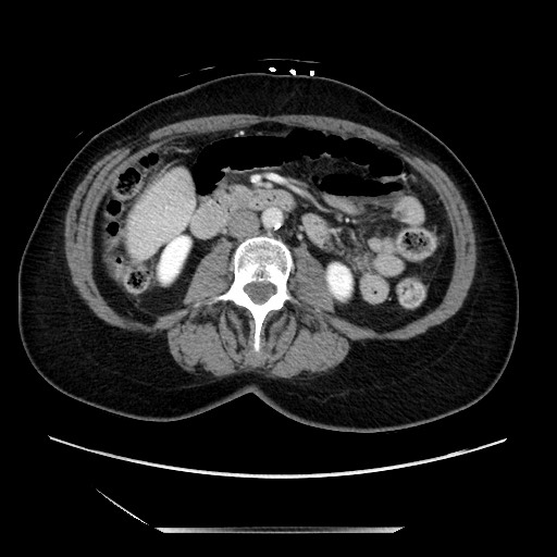 File:Closed loop small bowel obstruction due to adhesive bands - early and late images (Radiopaedia 83830-99014 A 68).jpg