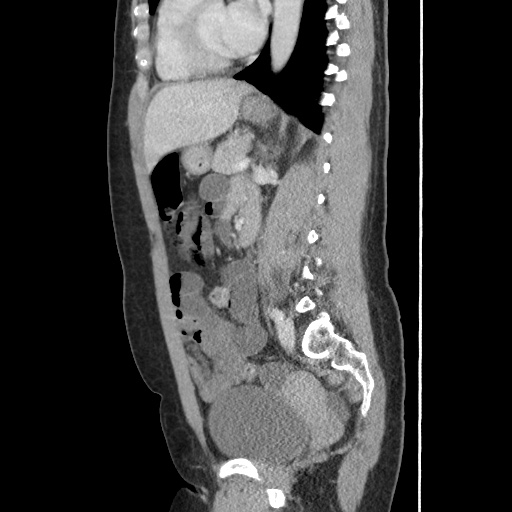 File:Closed loop small bowel obstruction due to trans-omental herniation (Radiopaedia 35593-37109 C 39).jpg