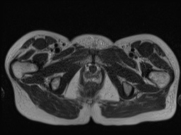 Closed loop small bowel obstruction in pregnancy (MRI) (Radiopaedia 87637-104031 D 43).jpg
