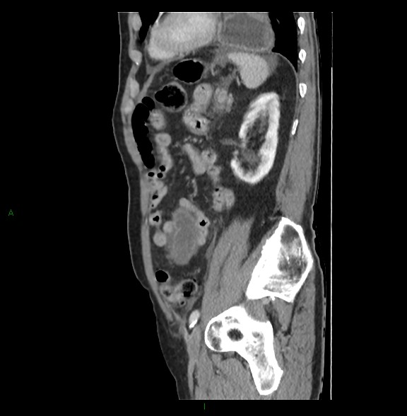 Closed loop small bowel obstruction with ischemia (Radiopaedia 84180-99456 C 66).jpg