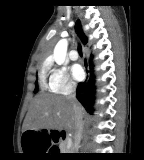 File:Coarctation of aorta (Radiopaedia 27427-27622 Sagittal C+ CTPA 52).png