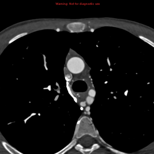 File:Coarctation of the aorta (Radiopaedia 12461-12697 A 114).jpg
