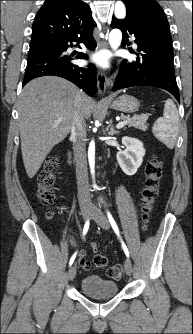 Coarctation of the aorta (Radiopaedia 74632-88521 B 129).jpg