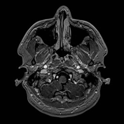 File:Cochlear incomplete partition type III associated with hypothalamic hamartoma (Radiopaedia 88756-105498 Axial T1 C+ 36).jpg