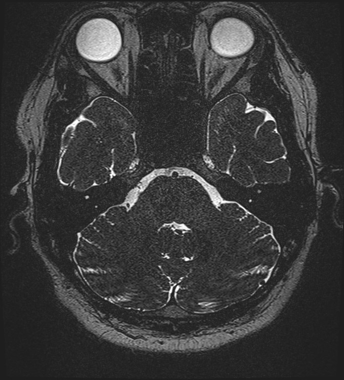 Cochlear incomplete partition type III associated with hypothalamic hamartoma (Radiopaedia 88756-105498 Axial T2 86).jpg