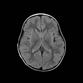 File:Cochlear nerve aplasia - unilateral (Radiopaedia 87910-104413 Axial FLAIR 18).jpg