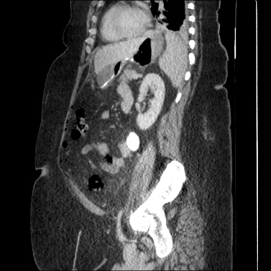 File:Collection due to leak after sleeve gastrectomy (Radiopaedia 55504-61972 C 28).jpg