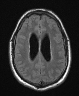 File:Colloid cyst (Radiopaedia 44510-48181 Axial FLAIR 20).png