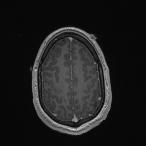File:Colloid cyst (Radiopaedia 44510-48181 Axial T1 C+ 148).png