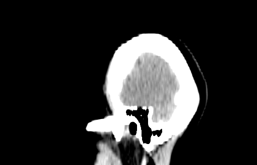 Colloid cyst (Radiopaedia 88663-105373 C 4).jpg