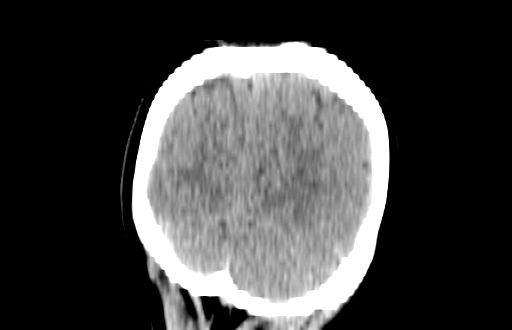 Colloid cyst (Radiopaedia 88663-105373 Coronal non-contrast 59).jpg