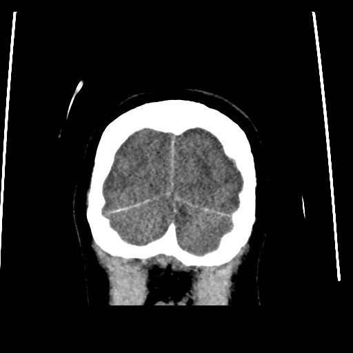Colloid cyst (resulting in death) (Radiopaedia 33423-34469 Coronal non-contrast 50).png