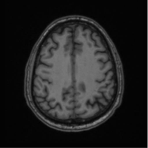 File:Colloid cyst of the third ventricle (Radiopaedia 86571-102662 Axial T1 58).png