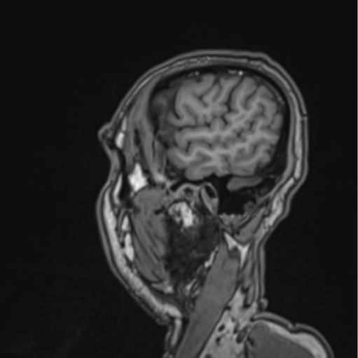 Colloid cyst of the third ventricle (Radiopaedia 86571-102662 Sagittal T1 67).png