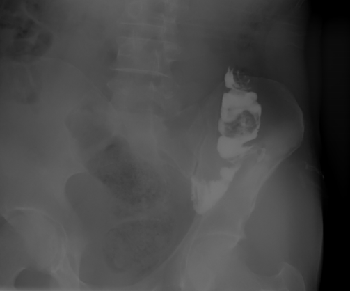 File:Colocutaneous fistula (Radiopaedia 71434-81774 D 1).PNG