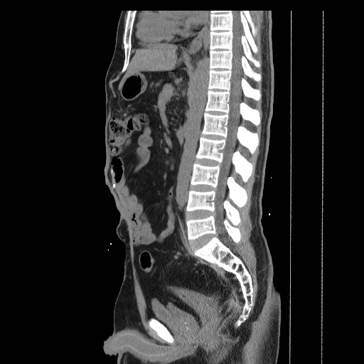 File:Colocutaneous fistula in Crohn's disease (Radiopaedia 29586-30093 C 25).jpg