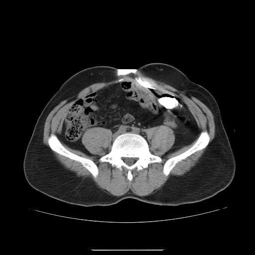 File:Colocutaneous fistula in Crohn's disease (Radiopaedia 29586-30093 D 18).jpg