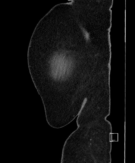 Colon adenocarcinoma (Radiopaedia 59374-66735 C 5).jpg