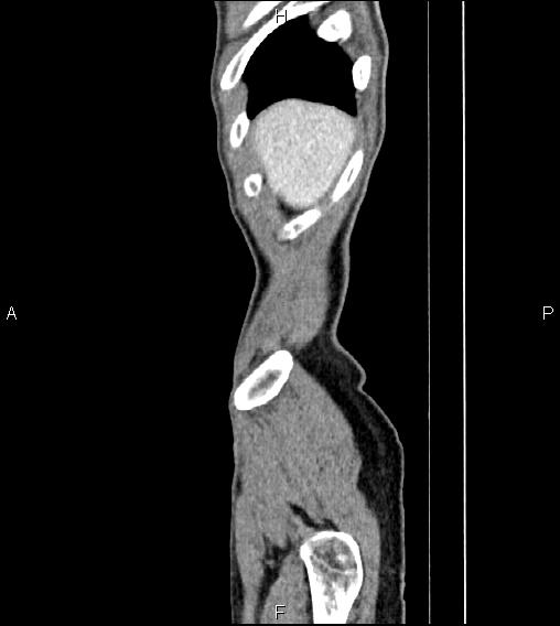Colon adenocarcinoma - hepatic flexure (Radiopaedia 85635-101395 D 3).jpg
