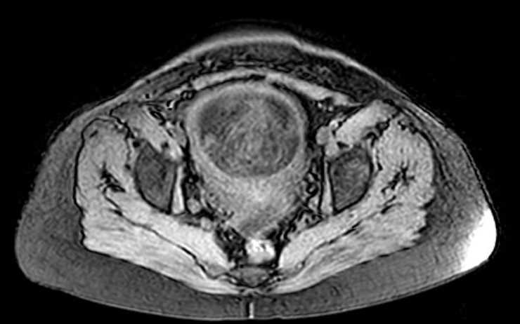 Colon adenocarcinoma with Krukenberg tumors, advanced pregnancy (Radiopaedia 67279-76645 A 16).jpg