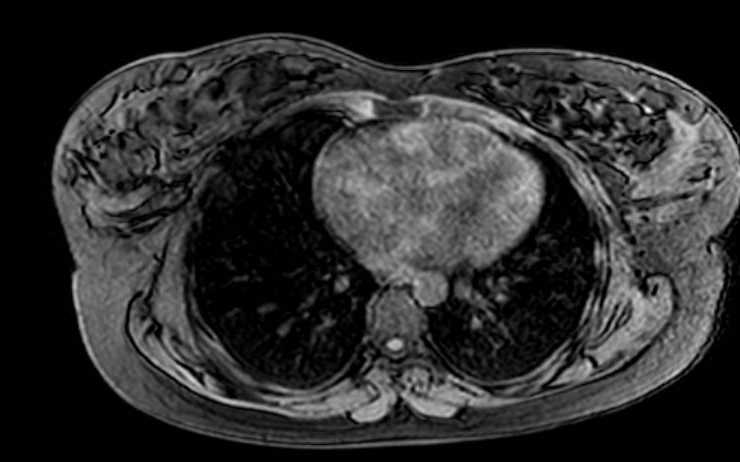 File:Colon adenocarcinoma with Krukenberg tumors, advanced pregnancy (Radiopaedia 67279-76645 A 82).jpg