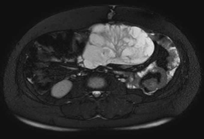 Colon adenocarcinoma with Krukenberg tumors, advanced pregnancy (Radiopaedia 67279-76645 Axial T2 SPAIR 41).jpg
