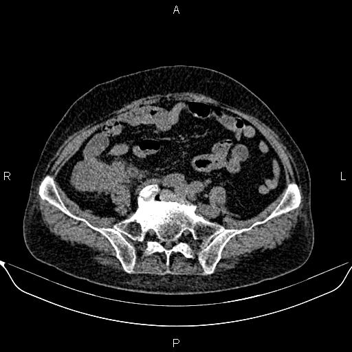 File:Colon cancer (Radiopaedia 90215-107432 Axial non-contrast 64).jpg