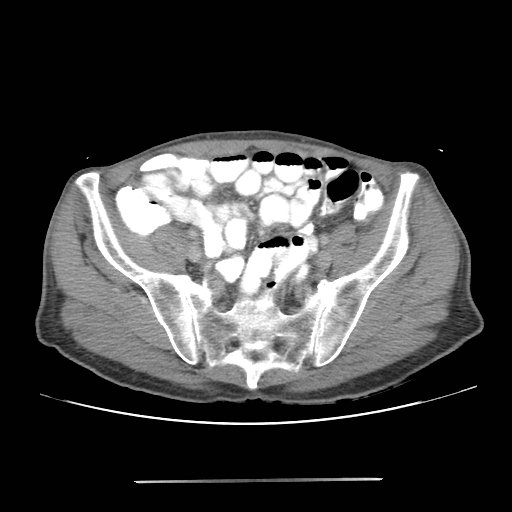 File:Colon cancer with calcified liver metastasis (Radiopaedia 74423-85307 A 60).jpg