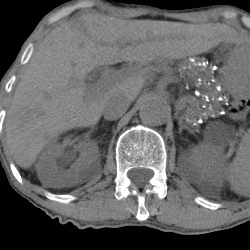 Colon cancer with calcified liver metastasis (Radiopaedia 74423-85309 Axial non-contrast 27).jpg