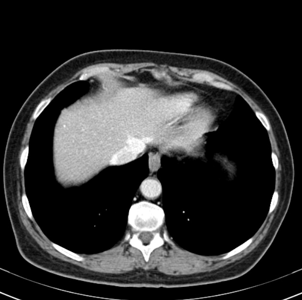 Colon carcinoma with hepatic metastases (Radiopaedia 29477-29961 A 12).jpg