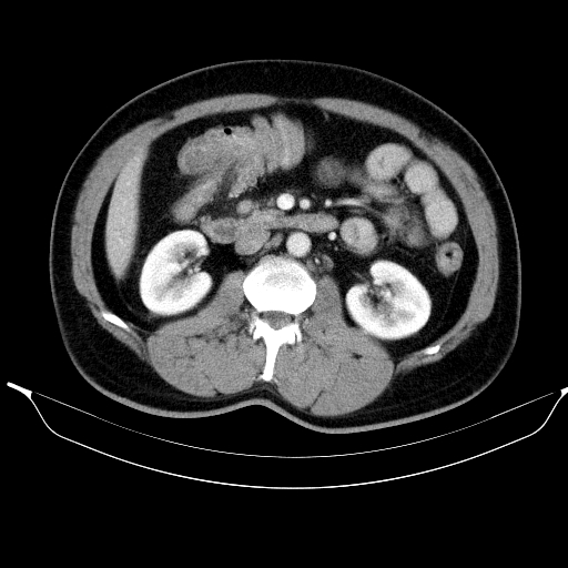 Colonic lipoma with colo-colic intussusception (Radiopaedia 58944-66200 A 28).jpg