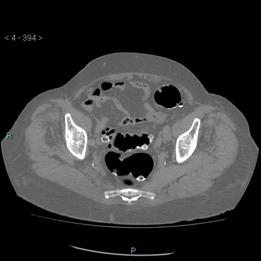 Colonic lipomas (Radiopaedia 49137-54244 Axial bone window 176).jpg