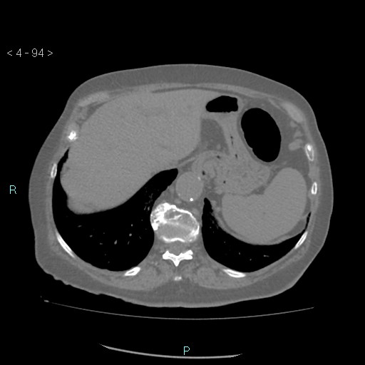 File:Colonic lipomas (Radiopaedia 49137-54244 Axial bone window 42).jpg