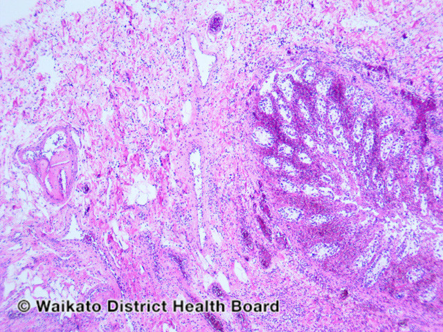 File:Figure 2 (DermNet NZ pathology-w-cholesterol-emboli-fig-2).jpg