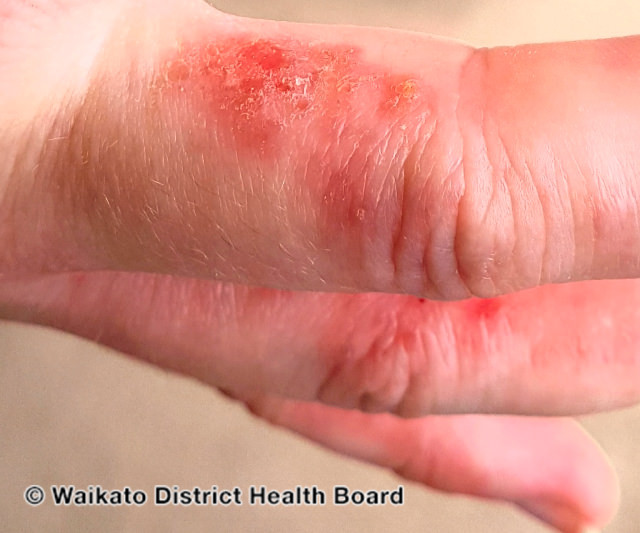 File:Hand dermatitis (DermNet NZ contact-dermatitis-isocyanate-04).jpg