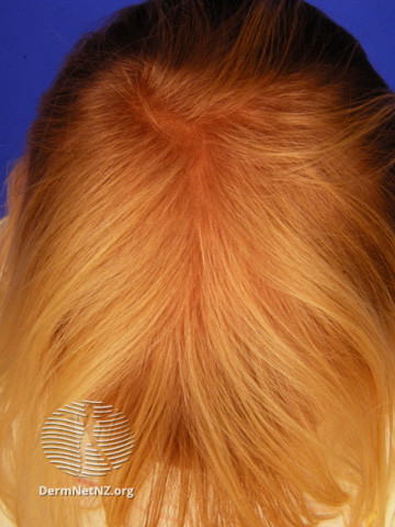 File:Loose anagen hair syndrome (DermNet NZ hair-nails-sweat-loose-anagen1).jpg
