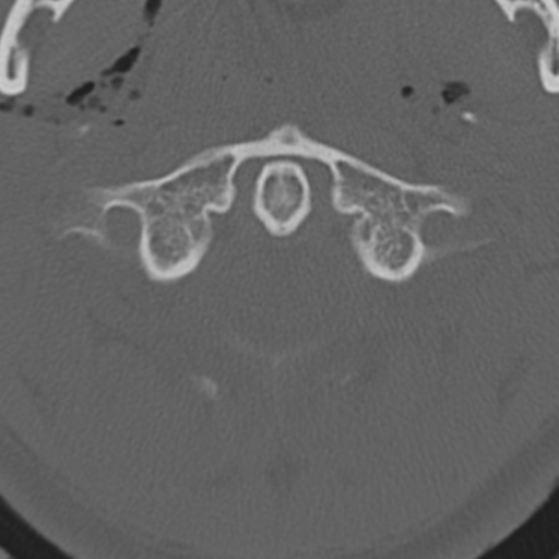 File:Multitrauma with diffuse axonal injury, temporal bone fractures and traumatic caroticocavernous fistula (Radiopaedia 37242-39035 Axial 217).png