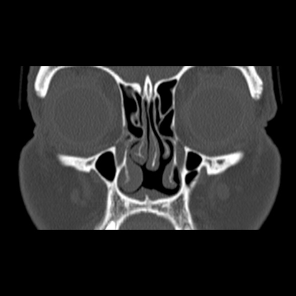 File:Nasal septal perforation (Radiopaedia 25030-25289 Coronal bone window 23).jpg