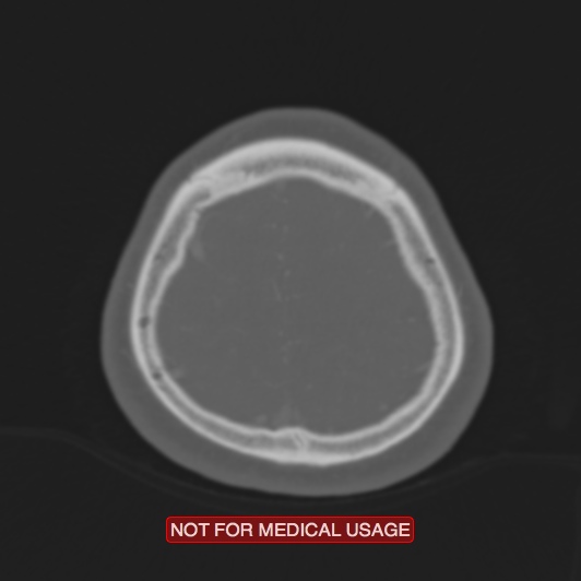 File:Nasopharyngeal carcinoma recurrence - skull base destruction (Radiopaedia 29107-29490 Axial bone window 17).jpg