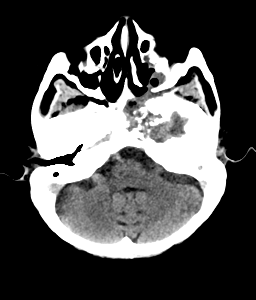 File:Nasopharyngeal carcinoma with cerebral abscess (Radiopaedia 43018-46275 Axial non-contrast 14).png