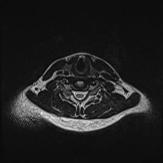 Nasopharyngeal carcinoma with perineural spread (Radiopaedia 55030-61380 Axial T2 69).jpg