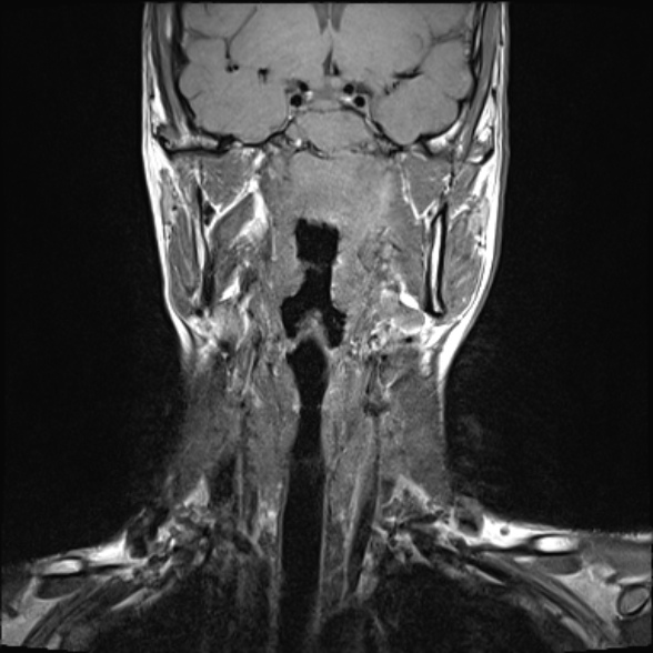 Nasopharyngeal carcinoma with skull base invasion (Radiopaedia 53415-59485 Coronal T1 21).jpg