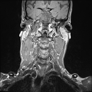 File:Nasopharyngeal carcinoma with skull base invasion (Radiopaedia 59258-66600 Coronal T1 14).jpg