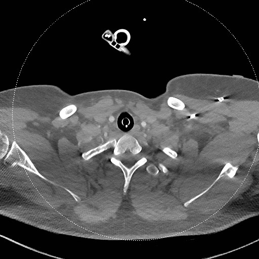 Neck CT angiogram (intraosseous vascular access) (Radiopaedia 55481-61945 B 110).jpg
