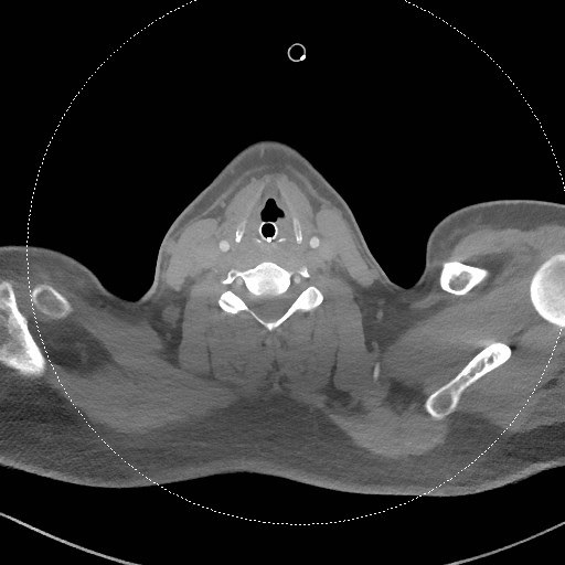 File:Neck CT angiogram (intraosseous vascular access) (Radiopaedia 55481-61945 B 158).jpg