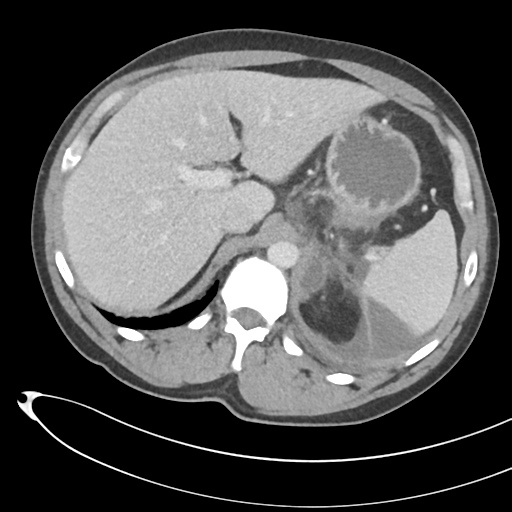 File:Necrotizing pancreatitis with acute necrotic collections (Radiopaedia 38829-41012 B 21).png