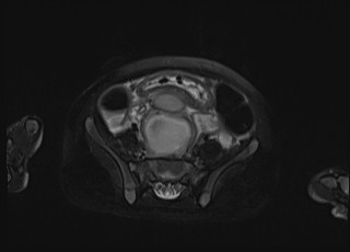 Neonatal prostatic utricle abscess - cyst (Radiopaedia 69511-79394 Axial T2 fat sat 29).jpg
