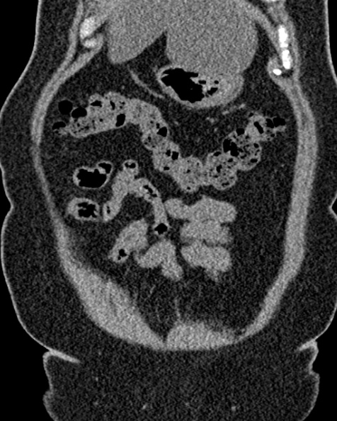 File:Nephrostomy for urosepsis (Radiopaedia 26180-26330 non-contrast 19).jpg